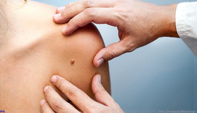 Pesquisadores desenvolvem composto que inibe crescimento de células do melanoma
