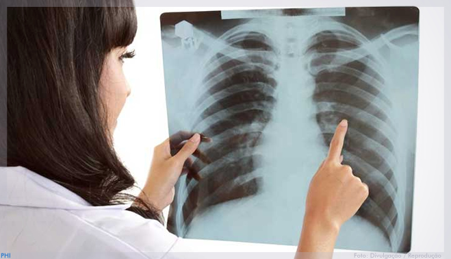 Farmacêuticas se unem para ampliar acesso ao diagnóstico molecular do câncer de pulmão